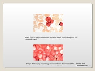 Reaksi Alpha- Napthylacetate esterase pada darah perifer, sel leukemia positif kuat. Pembesaran 1000X. Dengan aktifitas yang sangat tinnggi pada sel leukemia. Pembesaran 1000X. 09/14/11 Internet atlas Leukemia library 