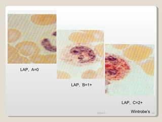 09/14/11 LAP,  A=0 LAP,  B=1+ LAP,  C=2+ Wintrobe’s 