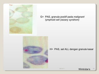09/14/11 G=  PAS, granula positif pada  malignant lymphoid cell (sezary syndrom) H=  PAS, sel ALL dengan granula kasar Wintrobe’s 
