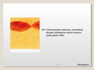 09/14/11 M=  Chloroasetate esterase , promielosit  dengan sitoplasma warna maroon, pada pasien AML Wintrobe’s 