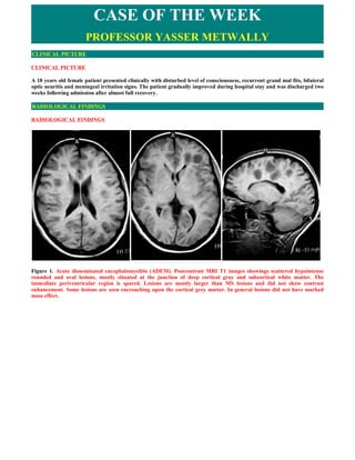 CASE OF THE WEEK
                       PROFESSOR YASSER METWALLY
CLINICAL PICTURE

CLINICAL PICTURE

A 18 years old female patient presented clinically with disturbed level of consciousness, recurrent grand mal fits, bilateral
optic neuritis and meningeal irritation signs. The patient gradually improved during hospital stay and was discharged two
weeks following admission after almost full recovery.

RADIOLOGICAL FINDINGS

RADIOLOGICAL FINDINGS  




Figure 1. Acute disseminated encephalomyelitis (ADEM). Postcontrast MRI T1 images showings scattered hypointense
rounded and oval lesions, mostly situated at the junction of deep cortical gray and subcortical white matter. The
immediate periventricular region is spared. Lesions are mostly larger than MS lesions and did not show contrast
enhancement. Some lesions are seen encroaching upon the cortical grey matter. In general lesions did not have marked
mass effect.
 