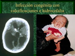 Infección congénita con
calcificaciones e hidrocefalia
 