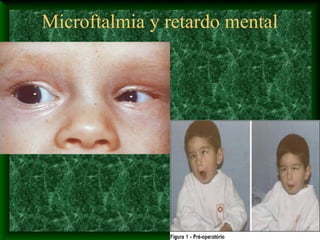 Microftalmia y retardo mental
 