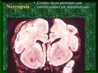 Necropsia
• Cerebro de un prematuro con
calcificaciones por toxoplasmosis
 
