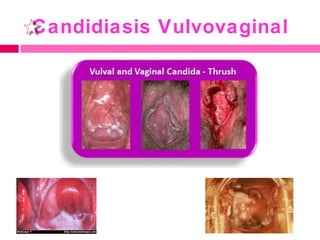 Candidiasis Vulvovaginal

 