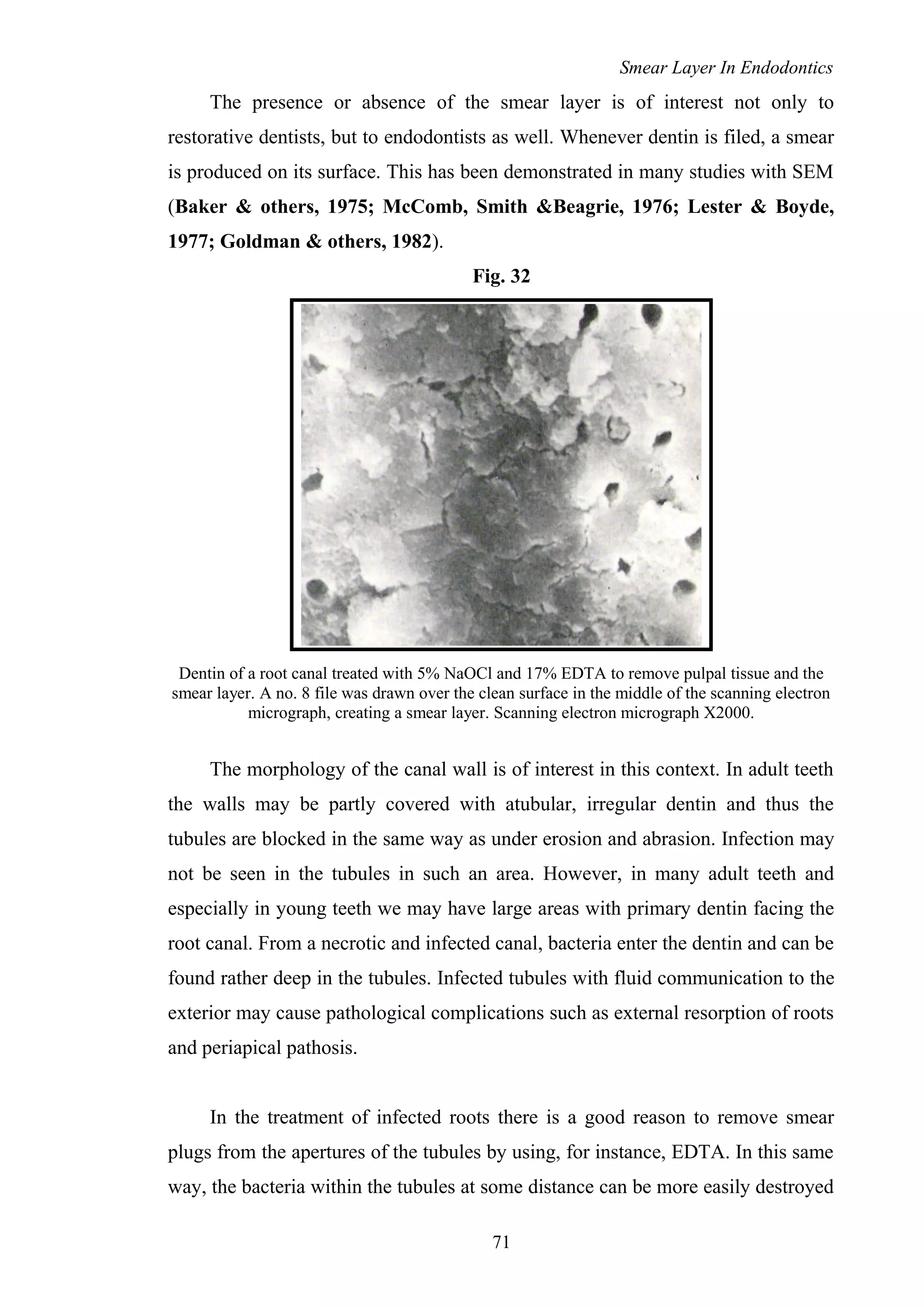 Smear Layer In Endodontics
The presence or absence of the smear layer is of interest not only to
restorative dentists, but to endodontists as well. Whenever dentin is filed, a smear
is produced on its surface. This has been demonstrated in many studies with SEM
(Baker & others, 1975; McComb, Smith &Beagrie, 1976; Lester & Boyde,
1977; Goldman & others, 1982).
Fig. 32
Dentin of a root canal treated with 5% NaOCl and 17% EDTA to remove pulpal tissue and the
smear layer. A no. 8 file was drawn over the clean surface in the middle of the scanning electron
micrograph, creating a smear layer. Scanning electron micrograph X2000.
The morphology of the canal wall is of interest in this context. In adult teeth
the walls may be partly covered with atubular, irregular dentin and thus the
tubules are blocked in the same way as under erosion and abrasion. Infection may
not be seen in the tubules in such an area. However, in many adult teeth and
especially in young teeth we may have large areas with primary dentin facing the
root canal. From a necrotic and infected canal, bacteria enter the dentin and can be
found rather deep in the tubules. Infected tubules with fluid communication to the
exterior may cause pathological complications such as external resorption of roots
and periapical pathosis.
In the treatment of infected roots there is a good reason to remove smear
plugs from the apertures of the tubules by using, for instance, EDTA. In this same
way, the bacteria within the tubules at some distance can be more easily destroyed
71
 