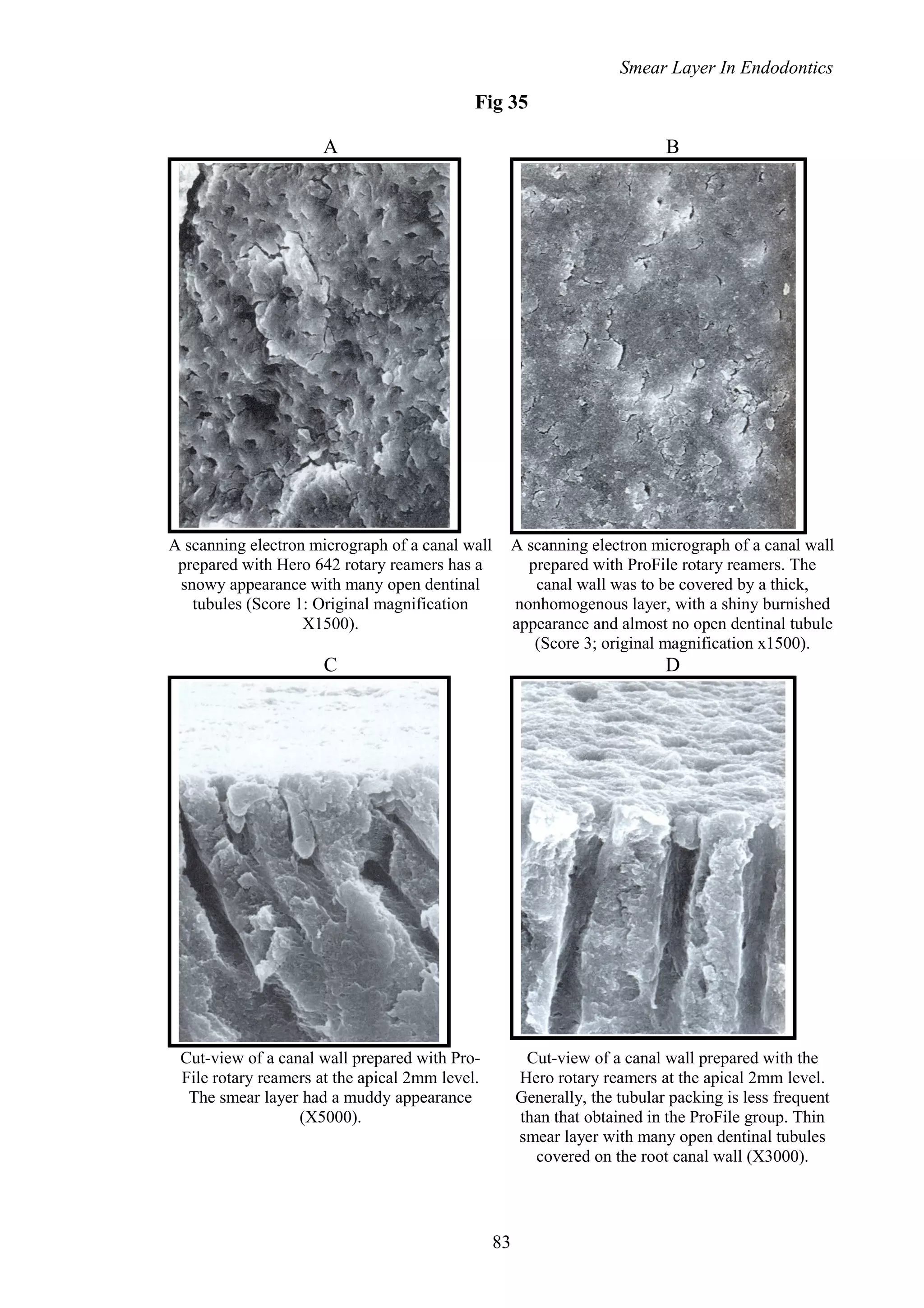 Smear Layer In Endodontics
Fig 35
A B
A scanning electron micrograph of a canal wall
prepared with Hero 642 rotary reamers has a
snowy appearance with many open dentinal
tubules (Score 1: Original magnification
X1500).
A scanning electron micrograph of a canal wall
prepared with ProFile rotary reamers. The
canal wall was to be covered by a thick,
nonhomogenous layer, with a shiny burnished
appearance and almost no open dentinal tubule
(Score 3; original magnification x1500).
C D
Cut-view of a canal wall prepared with Pro-
File rotary reamers at the apical 2mm level.
The smear layer had a muddy appearance
(X5000).
Cut-view of a canal wall prepared with the
Hero rotary reamers at the apical 2mm level.
Generally, the tubular packing is less frequent
than that obtained in the ProFile group. Thin
smear layer with many open dentinal tubules
covered on the root canal wall (X3000).
83
 