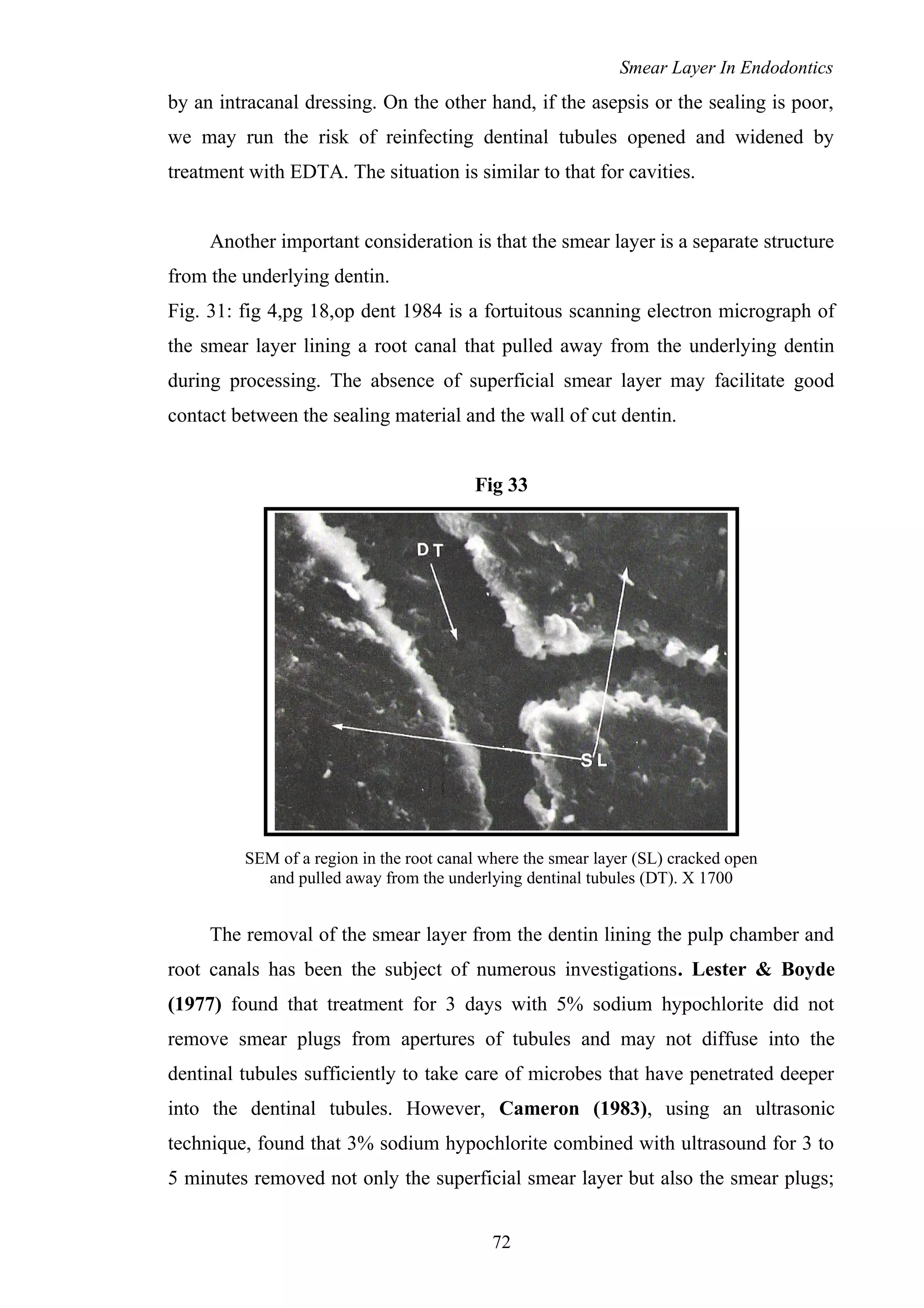 Smear Layer In Endodontics
by an intracanal dressing. On the other hand, if the asepsis or the sealing is poor,
we may run the risk of reinfecting dentinal tubules opened and widened by
treatment with EDTA. The situation is similar to that for cavities.
Another important consideration is that the smear layer is a separate structure
from the underlying dentin.
Fig. 31: fig 4,pg 18,op dent 1984 is a fortuitous scanning electron micrograph of
the smear layer lining a root canal that pulled away from the underlying dentin
during processing. The absence of superficial smear layer may facilitate good
contact between the sealing material and the wall of cut dentin.
Fig 33
SEM of a region in the root canal where the smear layer (SL) cracked open
and pulled away from the underlying dentinal tubules (DT). X 1700
The removal of the smear layer from the dentin lining the pulp chamber and
root canals has been the subject of numerous investigations. Lester & Boyde
(1977) found that treatment for 3 days with 5% sodium hypochlorite did not
remove smear plugs from apertures of tubules and may not diffuse into the
dentinal tubules sufficiently to take care of microbes that have penetrated deeper
into the dentinal tubules. However, Cameron (1983), using an ultrasonic
technique, found that 3% sodium hypochlorite combined with ultrasound for 3 to
5 minutes removed not only the superficial smear layer but also the smear plugs;
72
 
