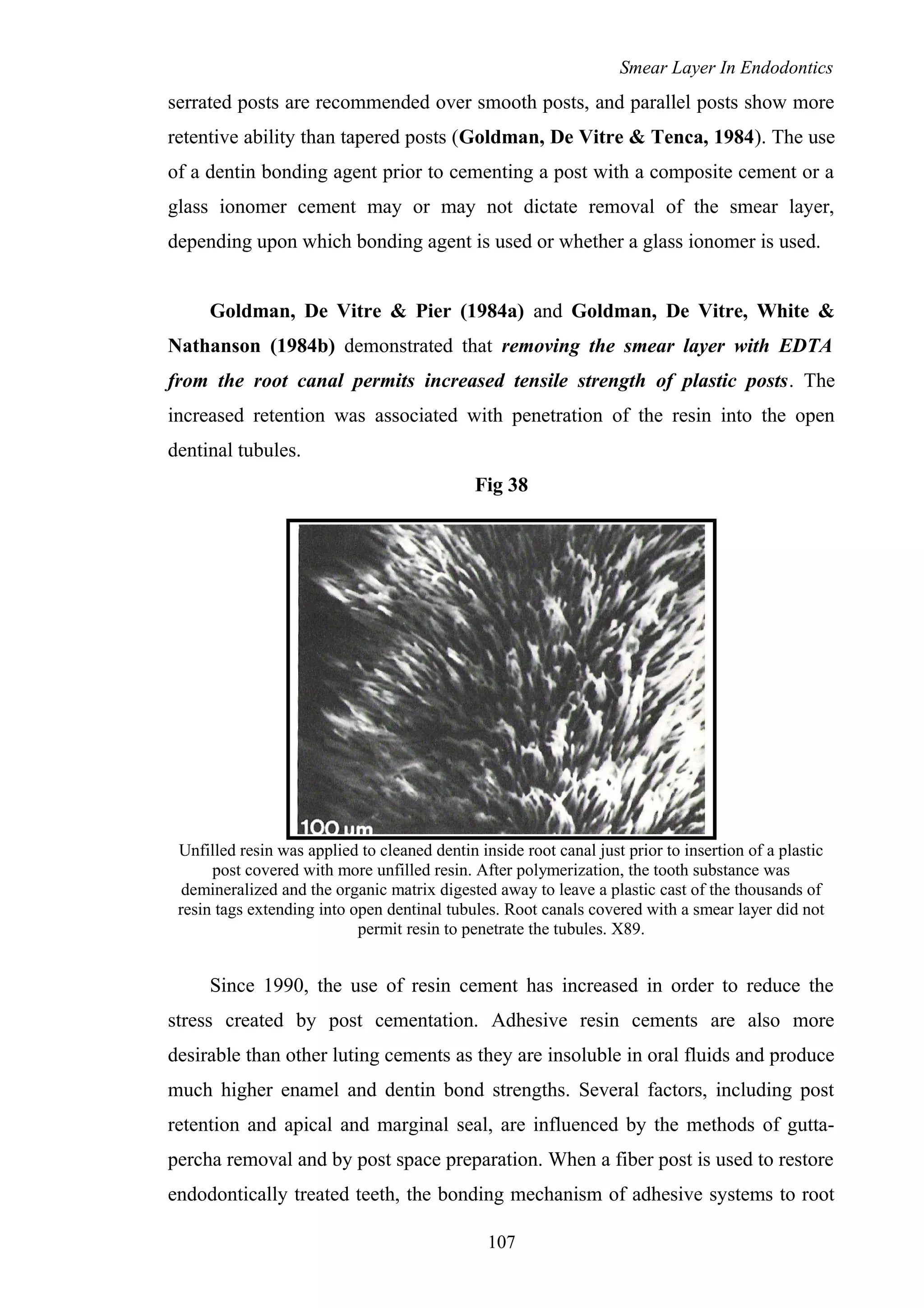 Smear Layer In Endodontics
serrated posts are recommended over smooth posts, and parallel posts show more
retentive ability than tapered posts (Goldman, De Vitre & Tenca, 1984). The use
of a dentin bonding agent prior to cementing a post with a composite cement or a
glass ionomer cement may or may not dictate removal of the smear layer,
depending upon which bonding agent is used or whether a glass ionomer is used.
Goldman, De Vitre & Pier (1984a) and Goldman, De Vitre, White &
Nathanson (1984b) demonstrated that removing the smear layer with EDTA
from the root canal permits increased tensile strength of plastic posts. The
increased retention was associated with penetration of the resin into the open
dentinal tubules.
Fig 38
Unfilled resin was applied to cleaned dentin inside root canal just prior to insertion of a plastic
post covered with more unfilled resin. After polymerization, the tooth substance was
demineralized and the organic matrix digested away to leave a plastic cast of the thousands of
resin tags extending into open dentinal tubules. Root canals covered with a smear layer did not
permit resin to penetrate the tubules. X89.
Since 1990, the use of resin cement has increased in order to reduce the
stress created by post cementation. Adhesive resin cements are also more
desirable than other luting cements as they are insoluble in oral fluids and produce
much higher enamel and dentin bond strengths. Several factors, including post
retention and apical and marginal seal, are influenced by the methods of gutta-
percha removal and by post space preparation. When a fiber post is used to restore
endodontically treated teeth, the bonding mechanism of adhesive systems to root
107
 