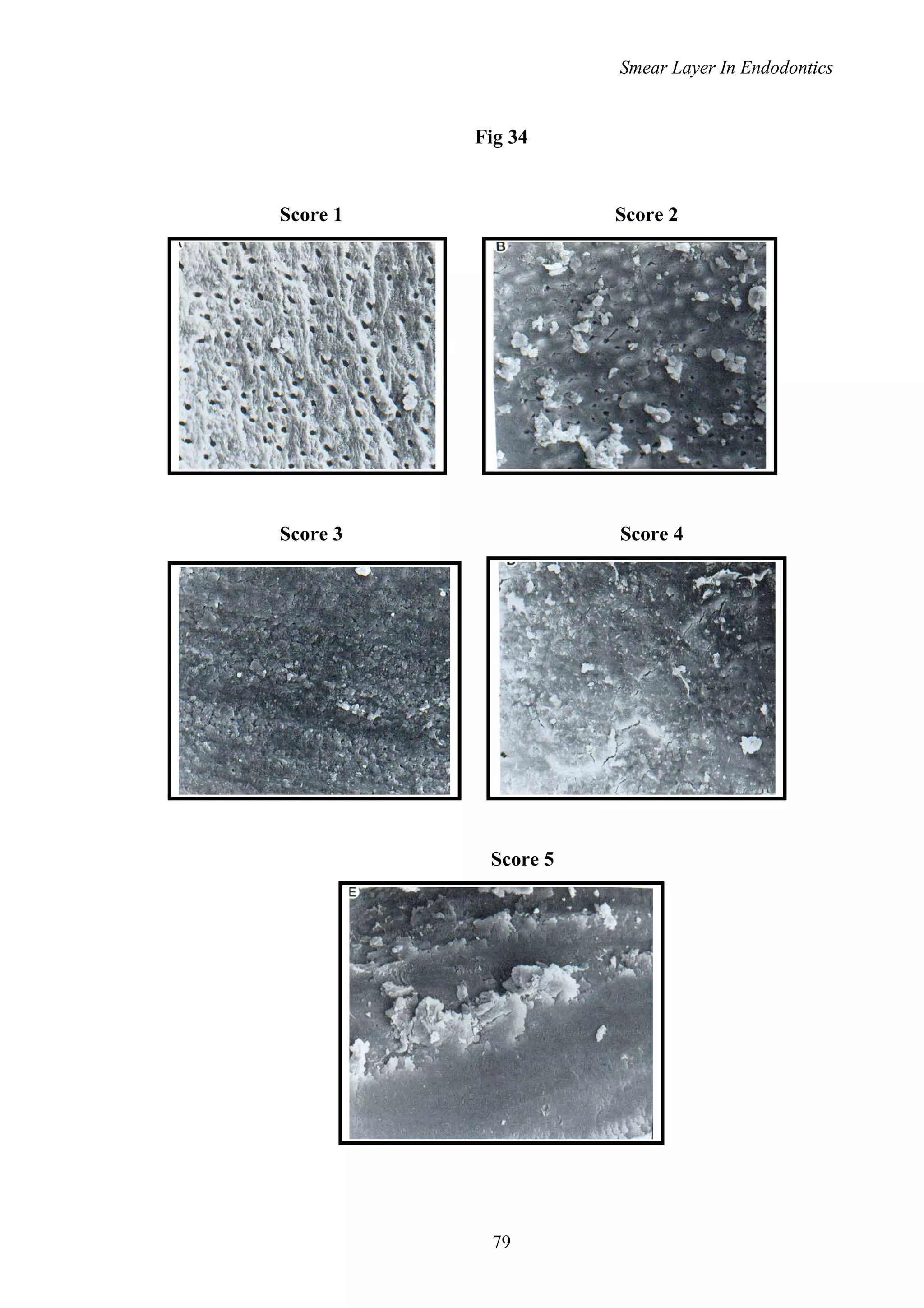 Smear Layer In Endodontics
Fig 34
Score 1 Score 2
Score 3 Score 4
Score 5
79
 
