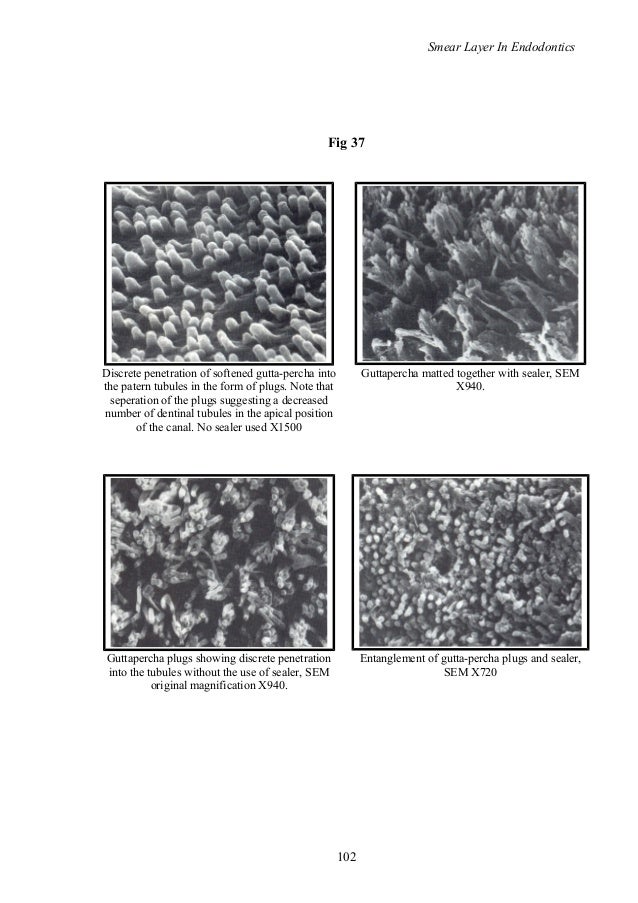 smear layer in endodontics/ rotary endodontic courses by indian denta…