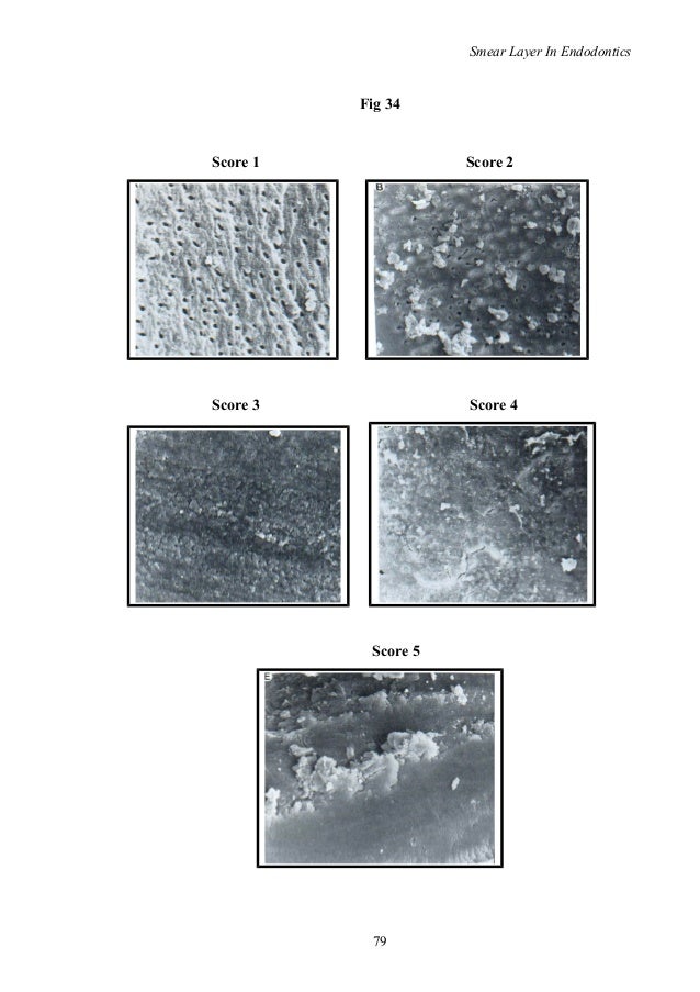 smear layer in endodontics/ rotary endodontic courses by indian denta…