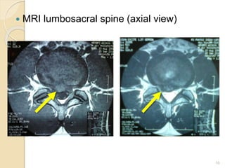  MRI lumbosacral spine (axial view)
10
 