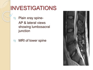 INVESTIGATIONS
1) Plain xray spine-
AP & lateral views
showing lumbosacral
junction
1) MRI of lower spine
 