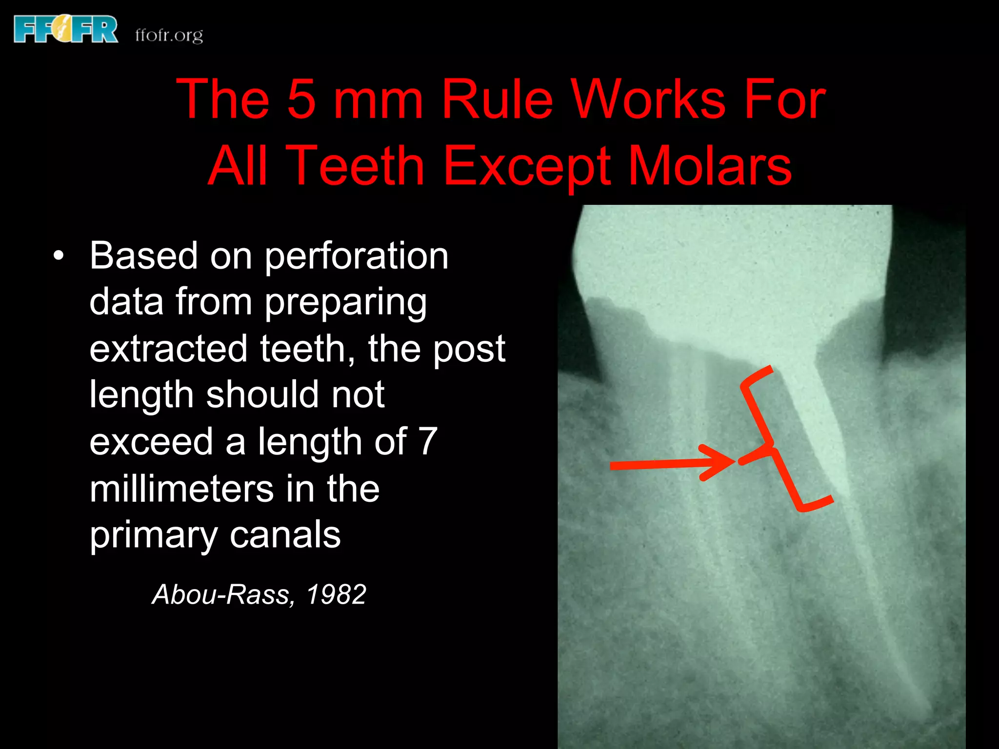 The 5 mm Rule Works For
All Teeth Except Molars
•  Based on perforation
data from preparing
extracted teeth, the post
length should not
exceed a length of 7
millimeters in the
primary canals
Abou-Rass, 1982
 