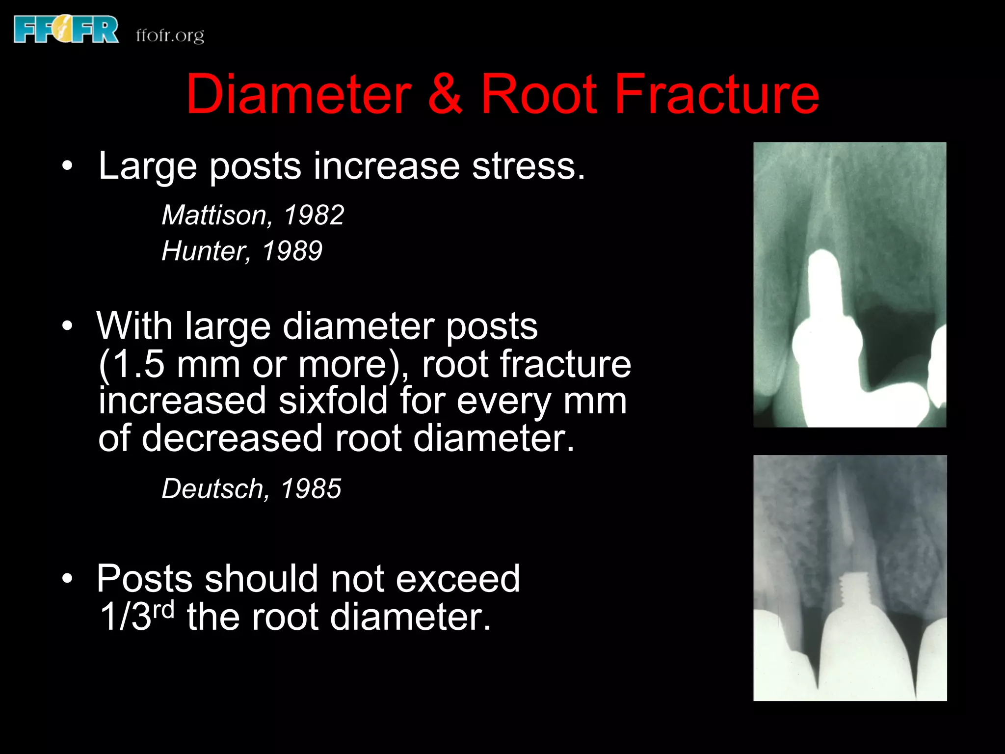 Diameter & Root Fracture
•  Large posts increase stress.
Mattison, 1982
Hunter, 1989
• With large diameter posts
(1.5 mm or more), root fracture
increased sixfold for every mm
of decreased root diameter.
Deutsch, 1985
• Posts should not exceed
1/3rd the root diameter.
 