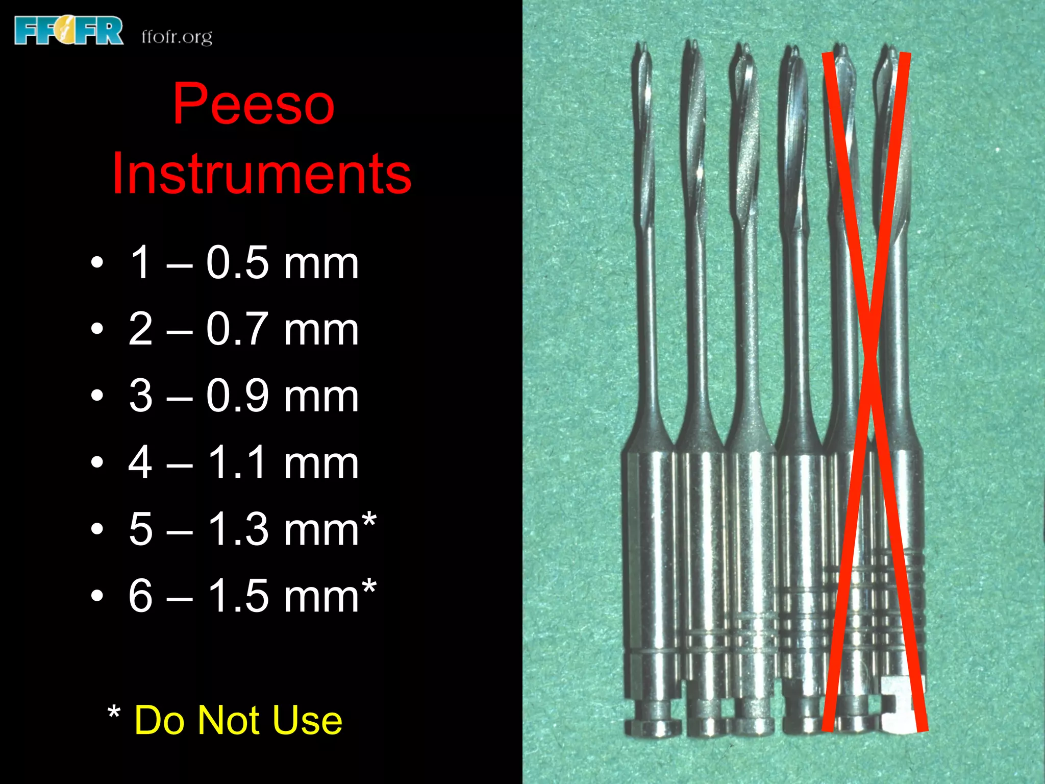 Peeso
Instruments
•  1 – 0.5 mm
•  2 – 0.7 mm
•  3 – 0.9 mm
•  4 – 1.1 mm
•  5 – 1.3 mm*
•  6 – 1.5 mm*
* Do Not Use
 