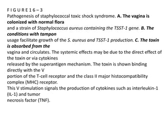 F I G U R E 1 6 – 3
Pathogenesis of staphylococcal toxic shock syndrome. A. The vagina is
colonized with normal flora
and a strain of Staphylococcus aureus containing the TSST-1 gene. B. The
conditions with tampon
usage facilitate growth of the S. aureus and TSST-1 production. C. The toxin
is absorbed from the
vagina and circulates. The systemic effects may be due to the direct effect of
the toxin or via cytokines
released by the superantigen mechanism. The toxin is shown binding
directly with the V
portion of the T-cell receptor and the class II major histocompatibility
complex (MHC) receptor.
This V stimulation signals the production of cytokines such as interleukin-1
(IL-1) and tumor
necrosis factor (TNF).
 