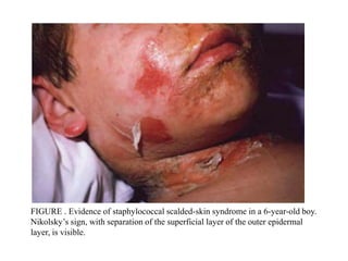 FIGURE . Evidence of staphylococcal scalded-skin syndrome in a 6-year-old boy.
Nikolsky’s sign, with separation of the superficial layer of the outer epidermal
layer, is visible.
 