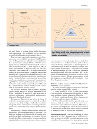 Medicine. 2013;11(38):2281-7 2283
ARRITMIAS
zón puede derivar en arritmias clínicas. Dichas alteraciones
pueden ser debidas a una modulación nerviosa, alteracio-
nes metabólicas, hipoxia y alteraciones electrolíticas.
En primer lugar, respecto a la modulación nerviosa, el siste-
ma nervioso autónomo (SNA) controla la actividad de marca-
pasos. El SNA parasimpático reduce la frecuencia de descarga
de las células marcapasos (fig. 2) al liberar acetilcolina (Ach) e
hiperpolarizar las células mediante un aumento de la conduc-
tancia de los canales de K+. El efecto supresor de la Ach se
emplea frecuentemente en la práctica clínica con fines tanto
diagnósticos como terapéuticos. En las taquicardias debidas al
aumento de automatismo normal, es esperable una reducción
transitoria de la frecuencia en respuesta a las maniobras vaga-
les (que fomentan la liberación de Ach), con una vuelta pro-
gresiva a la situación basal tras una transitoria aceleración al
cesar la maniobra (fenómeno denominado “taquicardia pos-
vagal”)4
. Por el contrario, la liberación de catecolaminas con
la activación del SNA simpático aumenta la permeabilidad de la
ICa-L incrementando la corriente de entrada de Ca2+ aumen-
tando de esta manera la frecuencia sinusal.
Las alteraciones metabólicas, como la hipoxia o la hipopo-
tasemia, pueden potenciar la actividad automática normal,
debido a la inhibición de la bomba de Na/K, reduciendo las
corrientes repolarizantes y aumentando la pendiente de re-
polarización diastólica de la fase 44
.
Los trastornos degenerativos que afectan al sistema de
conducción cardiaco pueden causar supresión de las células
marcapasos sinusales y dar lugar a bradicardia sinusal o in-
cluso parada sinusal. Un marcapasos subsidiario puede mani-
festarse como consecuencia de la supresión del automatismo
sinusal.
La característica distintiva del automatismo normal es la
supresión por sobreestimulación (overdrive suppression)5
. Este
fenómeno, mediado por la hiperactividad de la bomba de in-
tercambio de Na/K, condiciona una hiperpolarización tran-
sitoria de las células con automatismo intrínseco cuando son
hiperpolarizadas de forma repetitiva por estímulos externos
a una frecuencia superior a la propia. Una vez finalizada la
sobreestimulación, se produce un retorno gradual a la fre-
cuencia de descarga intrínseca que se denomina periodo de
calentamiento (fig. 3). El grado de supresión y el tiempo de re-
cuperación son proporcionales a la frecuencia y la duración
de la sobreestimulación aplicada6
. La ausencia de supresión por
sobreestimulación puede indicar que la arritmia se debe a un me-
canismo distinto del aumento de automatismo normal. Lo contra-
rio no siempre es cierto, dado que un automatismo normal
alterado puede no responder a la sobreestimulación a causa
de un bloqueo de entrada7
.
Arritmias cardiacas causadas por alteración del automatis-
mo normal. Son las siguientes:
1. Ritmos sinusales inapropiados: bradicardia sinusal, ta-
quicardia sinusal inapropiada por ejemplo.
2. Ritmos ectópicos de escape: en condiciones patológi-
cas, el deterioro de la función sinusal permite que un marca-
pasos subsidiario comande la formación del impulso.
3. Ritmos ectópicos acelerados, debido al aumento del
automatismo de los marcapasos subsidiarios.
4. Parasistolia: es un foco ectópico que se descarga a una
frecuencia fija y que actúa a modo de marcapasos sin co-
nexión con el resto de fenómenos eléctricos del corazón, lo
que supone que esté protegido por un bloqueo de entrada.
Es por tanto este un fenómeno debido tanto a la alteración
en la formación como en la conducción del impulso.
Automatismo anormal. Las células miocárdicas no marca-
pasos de las aurículas y ventrículos que en condiciones nor-
males no muestran actividad espontánea pueden presentar
propiedades de automatismo. Este automatismo anormal
Fig. 2. Representación de la actividad desencadenada. A. Pospotencial precoz.
B. Pospotencial tardío.
mVA
B
Postpotenciales
precoces
*
* *
*
* * *
0
-90
mV Postpotenciales
tardíos
0
-90
Fig. 3. Representación esquemática de la reentrada anatómica: el obstáculo
central establece dos vías. Cuando el impulso llega al circuito, se produce
un bloqueo unidireccional y la conducción lenta a través de la otra vía per-
mite que se inicie la reentrada.
Área
de tejido
inexcitable
Bloqueo
unidireccional
Conducción
lenta
 