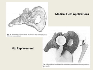 Medical Field Applications
Hip Replacement
 