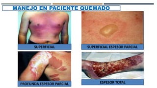 SUPERFICIAL SUPERFICIAL ESPESOR PARCIAL
PROFUNDA ESPESOR PARCIAL ESPESOR TOTAL
MANEJO EN PACIENTE QUEMADO
 