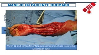 MANEJO EN PACIENTE QUEMADO
Paso de corriente
por vasos
sanguíneos y
nervios
TROMBOSIS LOCAL
LESIÓN NERVIOSA
PACIENTE SUELEN NECESITAR FASCIOTOMÍAS TRASLADAR A
CENTRO DE
TRAUMA PARA
TRATAMIENTO
Varón 12 a:Sd compartimental post quemadura.Se hace fasciotomía
c/liberación túnel
 