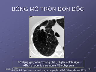 19October 31, 2014
BOÙNG MÔØ TROØN ÑÔN ÑOÄC
Bôø daïng gai,co keùo maøng phoåi, Rigler notch sign
Bronchogenic carcinoma /...