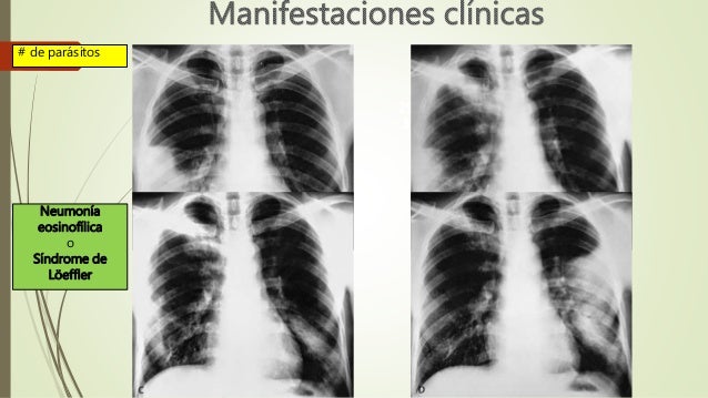 SINDROME DE LOEFFLER ASCARIS PDF DOWNLOAD SINDROME DE LOEFFLER ASCARIS PDF DOWNLOAD