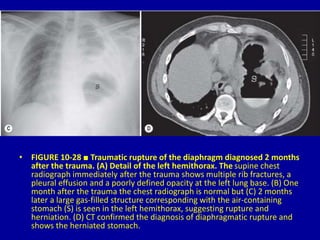 The Chest Wall, Pleura, Diaphragm and Intervention 10 Dr. Muhammad Bin ...