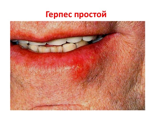 Вульгарный псориаз