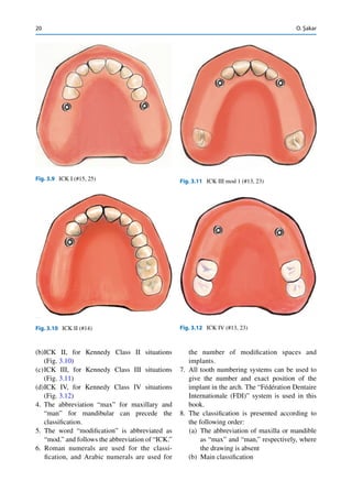 20
(b)ICK II, for Kennedy Class II situations
(Fig. 3.10)
(c)ICK III, for Kennedy Class III situations
(Fig. 3.11)
(d)ICK IV, for Kennedy Class IV situations
(Fig. 3.12)
4. The abbreviation “max” for maxillary and
“man” for mandibular can precede the
classiﬁcation.
5. The word “modiﬁcation” is abbreviated as
“mod.” and follows the abbreviation of “ICK.”
6. Roman numerals are used for the classi-
ﬁcation, and Arabic numerals are used for
the number of modiﬁcation spaces and
implants.
7. All tooth numbering systems can be used to
give the number and exact position of the
implant in the arch. The “Fédération Dentaire
Internationale (FDI)” system is used in this
book.
8. The classiﬁcation is presented according to
the following order:
(a) The abbreviation of maxilla or mandible
as “max” and “man,” respectively, where
the drawing is absent
(b) Main classiﬁcation
Fig. 3.9 ICK I (#15, 25)
Fig. 3.10 ICK II (#14) Fig. 3.12 ICK IV (#13, 23)
Fig. 3.11 ICK III mod 1 (#13, 23)
O. Şakar
 
