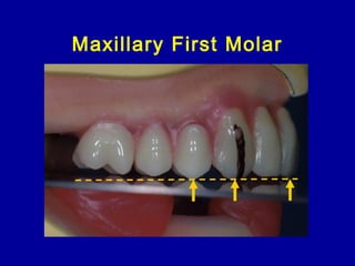 Maxillary First Molar
 