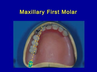 Maxillary First Molar
 