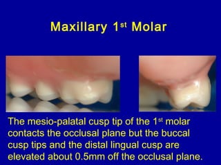 Maxillary 1st
Molar
The mesio-palatal cusp tip of the 1st
molar
contacts the occlusal plane but the buccal
cusp tips and the distal lingual cusp are
elevated about 0.5mm off the occlusal plane.
 