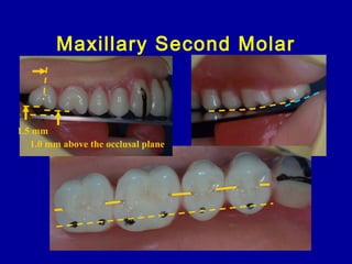 Maxillary Second Molar
1.0 mm above the occlusal plane
1.5 mm
 