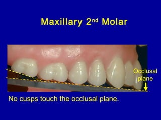 Maxillary 2nd
Molar
Occlusal
plane
No cusps touch the occlusal plane.
 