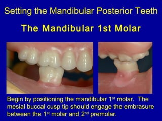 Setting the Mandibular Posterior Teeth
The Mandibular 1st Molar
Begin by positioning the mandibular 1st
molar. The
mesial buccal cusp tip should engage the embrasure
between the 1st
molar and 2nd
premolar.
 