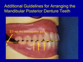 Additional Guidelines for Arranging the
Mandibular Posterior Denture Teeth
2/3 up the retromolar pad
 