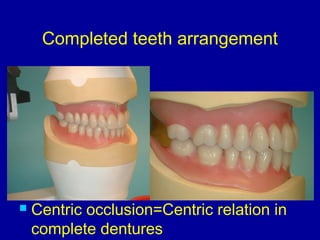 Completed teeth arrangement
 Centric occlusion=Centric relation in
complete dentures
 