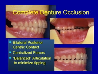 Complete Denture Occlusion
 Bilateral Posterior
Centric Contact
 Centralized Forces
 “Balanced” Articulation
to minimize tipping
 
