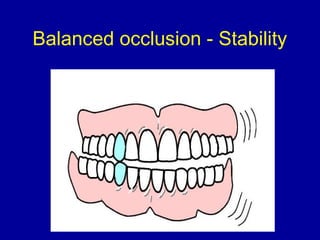 Balanced occlusion - Stability
 