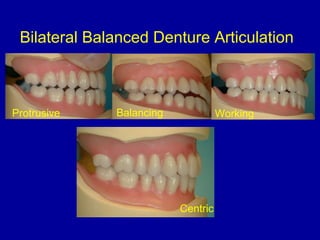 Bilateral Balanced Denture Articulation
Protrusive Balancing Working
Centric
 