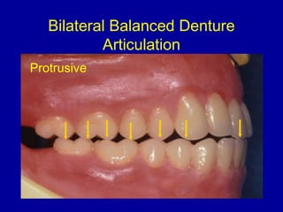 Bilateral Balanced Denture
Articulation
Protrusive
 