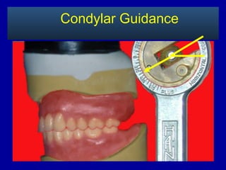 Condylar Guidance
 