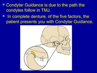  Condylar Guidance is due to the path the
condyles follow in TMJ.
 In complete denture, of the five factors, the
patient presents you with Condylar Guidance.
 