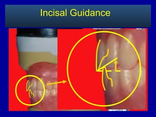Incisal Guidance
 