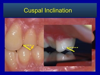 Cuspal Inclination
 