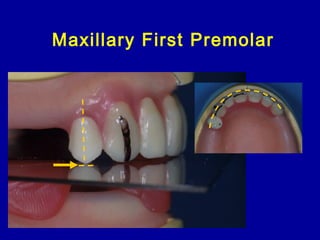 Maxillary First Premolar
 