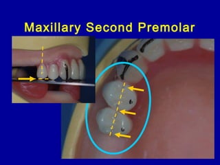 Maxillary Second Premolar
 